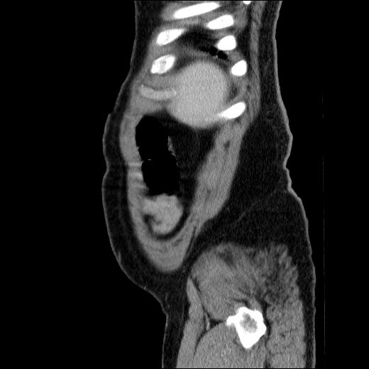 Obstructing ureteric calculus (Radiopaedia 49281-54373 C 15).jpg