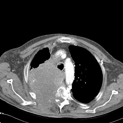 File:Obstructive superior vena cava tumor thrombus (Radiopaedia 28046-28306 A 14).jpg