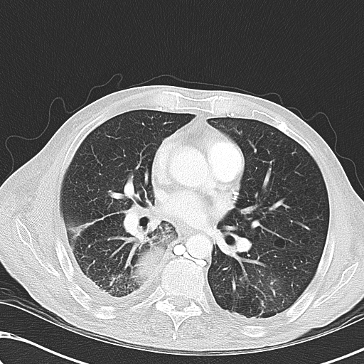 File:Obstructive superior vena cava tumor thrombus (Radiopaedia 28046-28306 Axial lung window 29).jpg