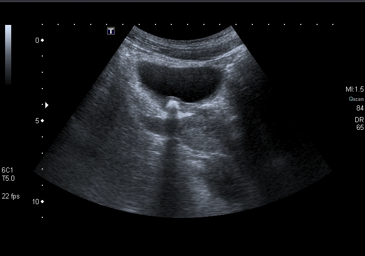 File:Obstructive uropathy and urolithiasis on ultrasound (Radiopaedia 25562-25758 E 1).jpg