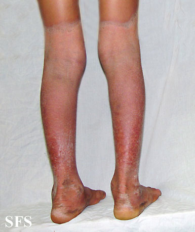 File:Pellagra (Dermatology Atlas 36).jpg