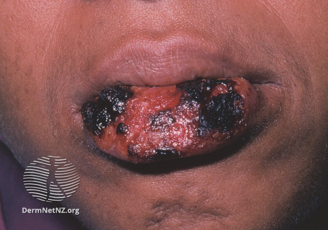 File:(DermNet NZ herpes-simplex-labialis-08).jpg