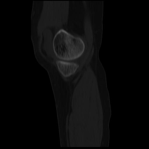 File:ACL avulsion fracture (Radiopaedia 33833-34994 Sagittal bone window 36).jpg