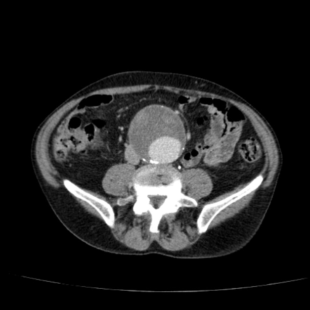 Abdominal aortic aneurysm (Radiopaedia 29248-29660 Axial C+ portal venous phase 38).jpg
