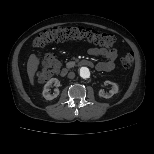 File:Abdominal aortic aneurysm (Radiopaedia 57318-64259 Axial C+ arterial phase 33).jpg