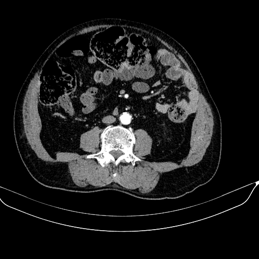 File:Abdominal aortic aneurysm (Radiopaedia 67117-76452 Axial C+ arterial phase 76).jpg