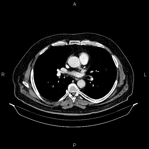 Abdominal aortic aneurysm (Radiopaedia 83094-97462 Axial renal cortical phase 40).jpg