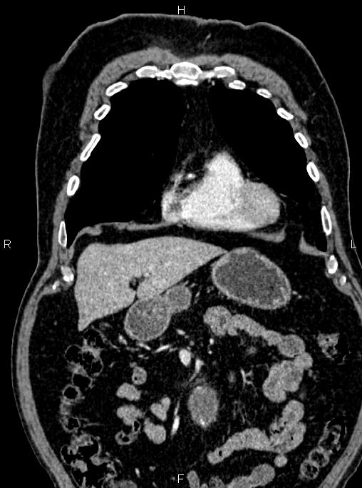 Abdominal aortic aneurysm (Radiopaedia 83094-97462 Coronal renal cortical phase 31).jpg