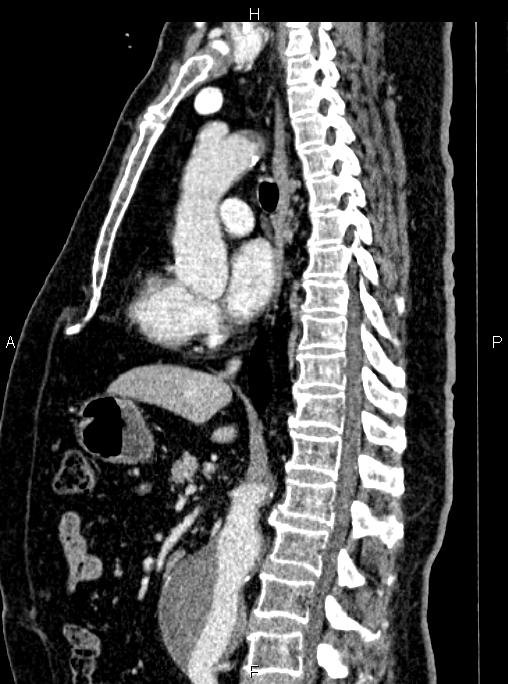 Abdominal aortic aneurysm (Radiopaedia 83094-97462 Sagittal renal cortical phase 65).jpg