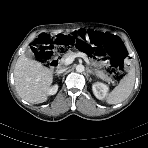 Abdominal aortic aneurysm (Radiopaedia 83581-98689 Axial C+ portal venous phase 37).jpg