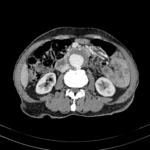 File:Abdominal aortic aneurysm (Radiopaedia 83581-98689 Axial C+ portal venous phase 57).jpg