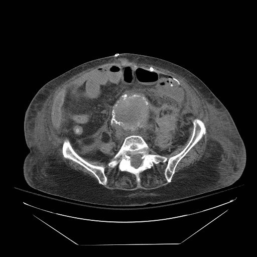 File:Abdominal aortic aneurysm - impending rupture (Radiopaedia 19233-19247 Axial non-contrast 112).jpg