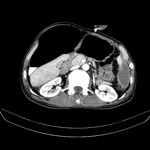 File:Abdominal collection due to previous cecal perforation (Radiopaedia 80831-94320 Axial C+ portal venous phase 76).jpg