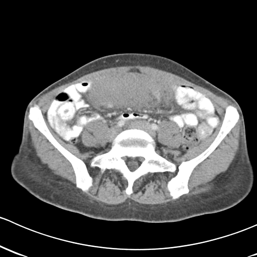 Abdominal desmoid tumor (Radiopaedia 41007-43740 Axial C+ portal venous phase 47).png