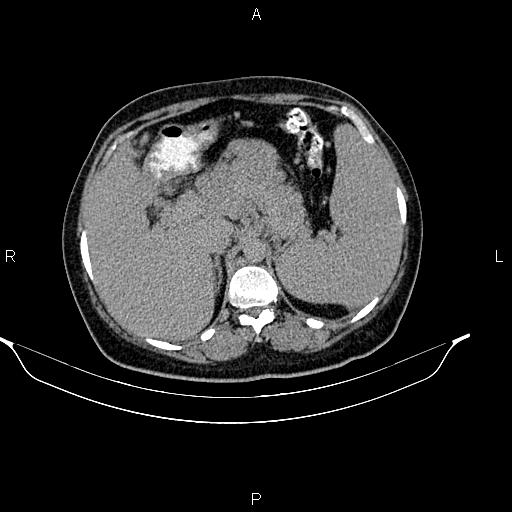 Abdominal lymphoma with sandwich sign (Radiopaedia 84378-99704 Axial C+ delayed 13).jpg