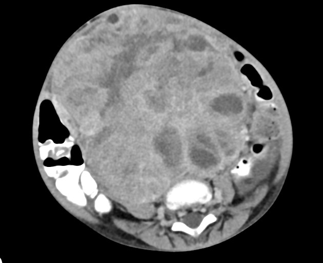 Abdominopelvic rhabdomyosarcoma (Radiopaedia 78356-90984 Axial C+ portal venous phase 111).jpg