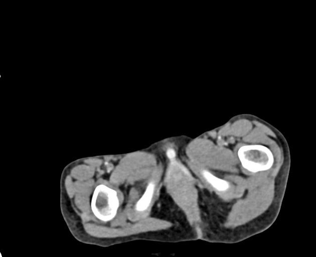 File:Abdominopelvic rhabdomyosarcoma (Radiopaedia 78356-90984 Axial C+ portal venous phase 162).jpg