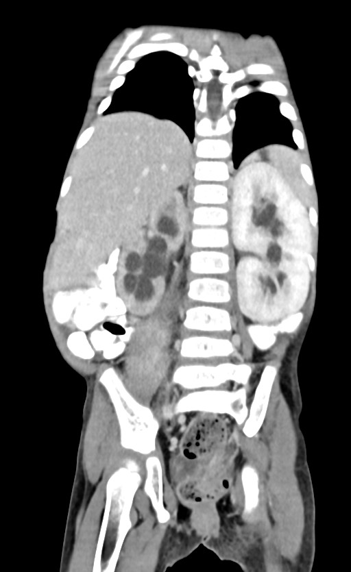 Abdominopelvic rhabdomyosarcoma (Radiopaedia 78356-90984 Coronal C+ portal venous phase 68).jpg