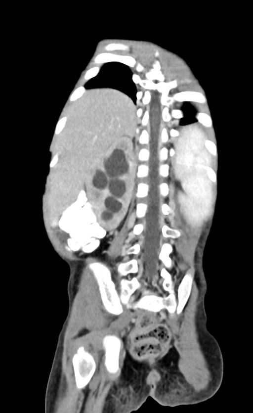 Abdominopelvic rhabdomyosarcoma (Radiopaedia 78356-90984 Coronal C+ portal venous phase 74).jpg