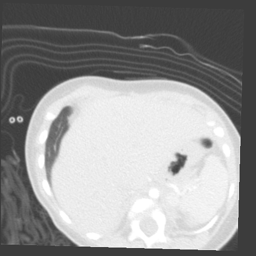 File:Aberrant left pulmonary artery (pulmonary sling) (Radiopaedia 42323-45435 Axial lung window 39).jpg