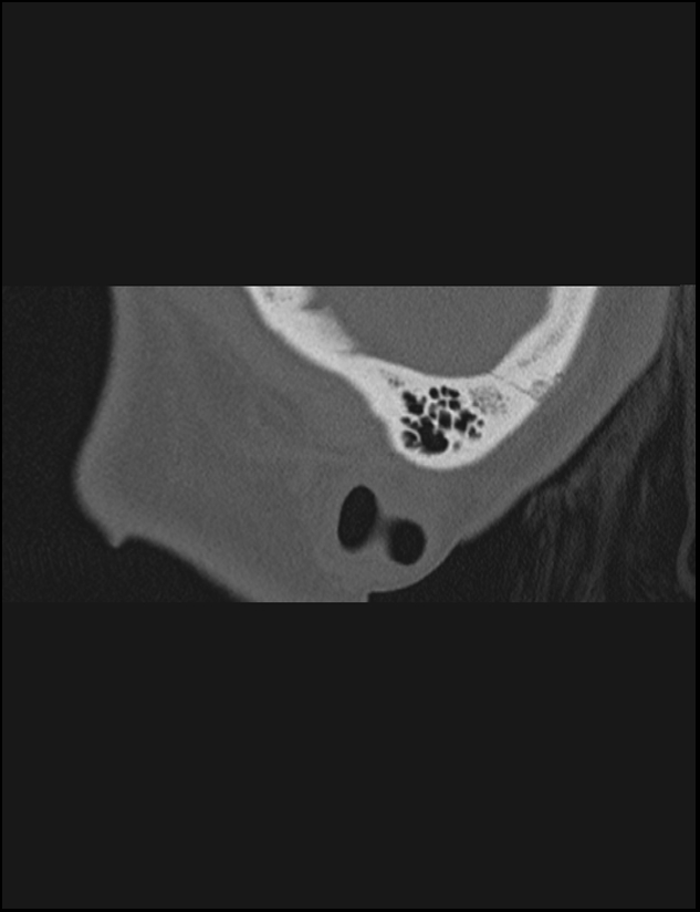 Aberrant right internal carotid artery (Radiopaedia 65191-74198 Sagittal non-contrast 9).jpg
