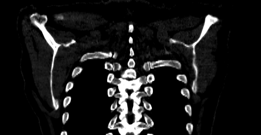 Accesory rib joint (Radiopaedia 71987-82452 Coronal bone window 71).jpg