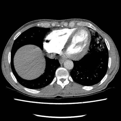 Accessory left horizontal fissure with lingular pneumonia (Radiopaedia 53763-59843 Axial C+ CTPA 70).jpg