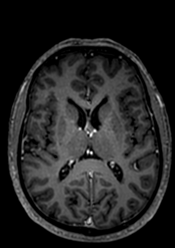 Accessory middle cerebral artery (Radiopaedia 73114-83828 Axial T1 C+ 15).jpg