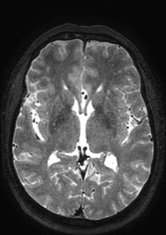 Accessory middle cerebral artery (Radiopaedia 73114-83828 Axial T2 69).jpg