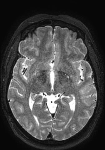 File:Accessory middle cerebral artery (Radiopaedia 73114-83828 Axial T2 89).jpg