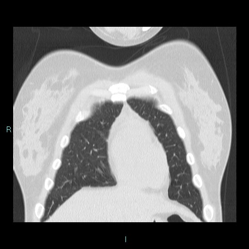 Accidental foreign body aspiration (seamstress needle) (Radiopaedia 77740-89983 Coronal lung window 54).jpg