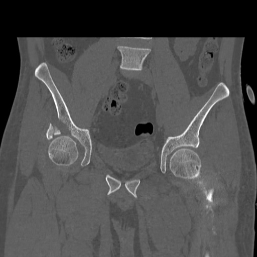 File:Acetabular and ilial fractures (Radiopaedia 59084-66378 Coronal bone window 22).jpg