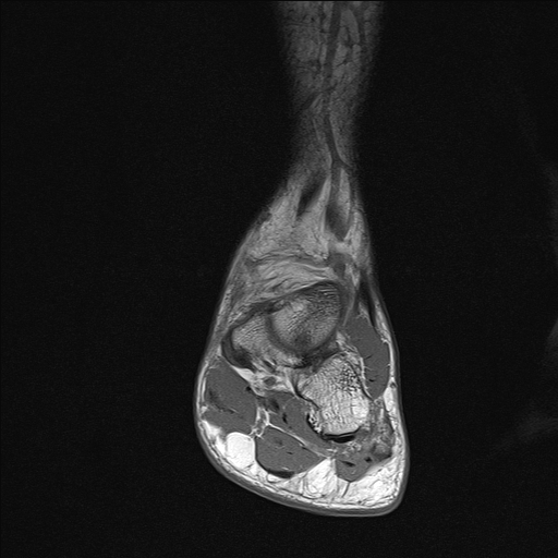 File:Achilles tendon tear (Radiopaedia 77615-89819 Coronal T1 11).jpg