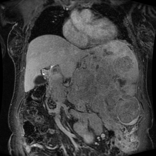Acinar cell carcinoma of the pancreas (Radiopaedia 75442-86668 Coronal T1 C+ fat sat 120).jpg