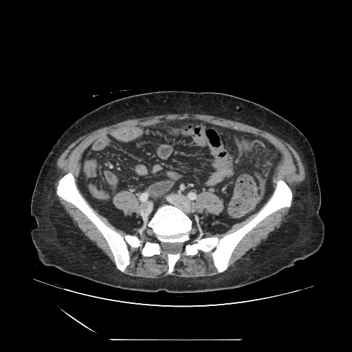 File:Acinar cell carcinoma of the pancreas (Radiopaedia 75442-86669 Axial C+ portal venous phase 101).jpg