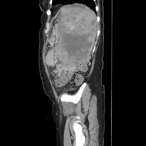 Acinar cell carcinoma of the pancreas (Radiopaedia 75442-86669 Sagittal C+ portal venous phase 155).jpg