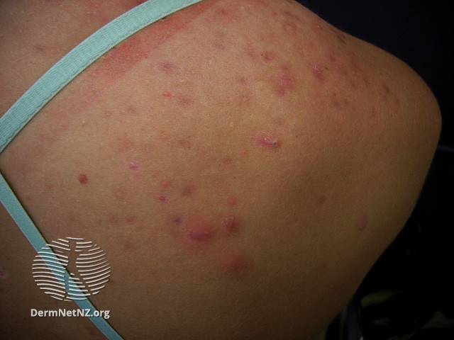 File:Acne affecting the back images (DermNet NZ acne-acne-back-152).jpg