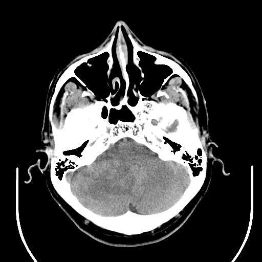 File:Acoustic schwannoma (Radiopaedia 29488-29982 AXIAL THICK non-contrast 11).jpg