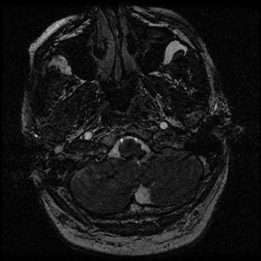 File:Acoustic schwannoma (Radiopaedia 39170-41387 Axial FIESTA 21).png