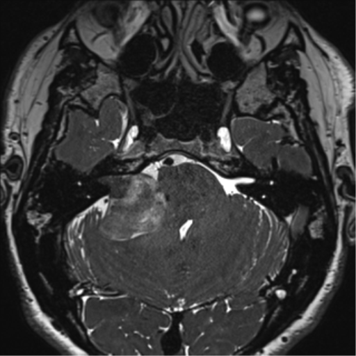 File:Acoustic schwannoma (Radiopaedia 50846-56358 Axial T2 23).png