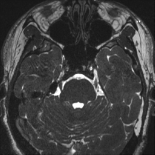 Acoustic schwannoma (translabyrinthine resection) (Radiopaedia 43570-46972 Axial CISS 42).png