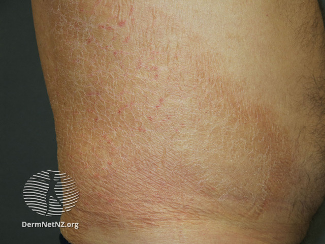 File:Acquired ichthyosis (DermNet NZ scaly-acquired-ichthyosis-2).jpg