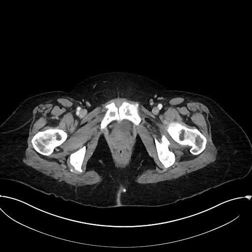 Active Crohn disease (Radiopaedia 59394-66750 Axial C+ portal venous phase 72).jpg