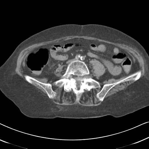 Active bleeding from duodenal ulcer with embolization (Radiopaedia 34216-35481 Axial non-contrast 41).png