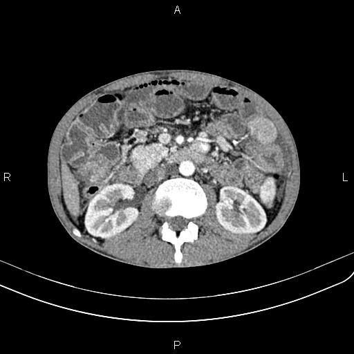 Active crohn disease (Radiopaedia 87133-103397 Axial C+ arterial phase 47).jpg