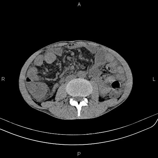 Active crohn disease (Radiopaedia 87133-103397 Axial non-contrast 54).jpg