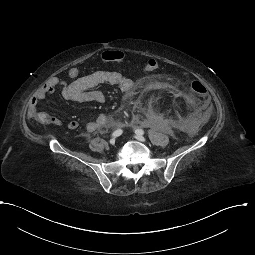File:Active renal extravasation with large subcapsular and retroperitoneal hemorrhage (Radiopaedia 60975-68796 Axial 244).jpg