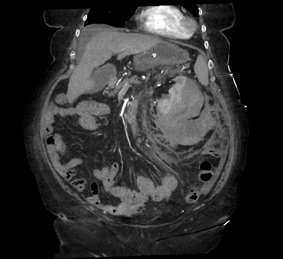 Active renal extravasation with large subcapsular and retroperitoneal hemorrhage (Radiopaedia 60975-68796 Coronal C+ arterial phase 57).jpg
