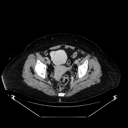 File:Acute appendicitis, heterotaxy syndrome (Radiopaedia 66884-76202 Axial 76).jpg