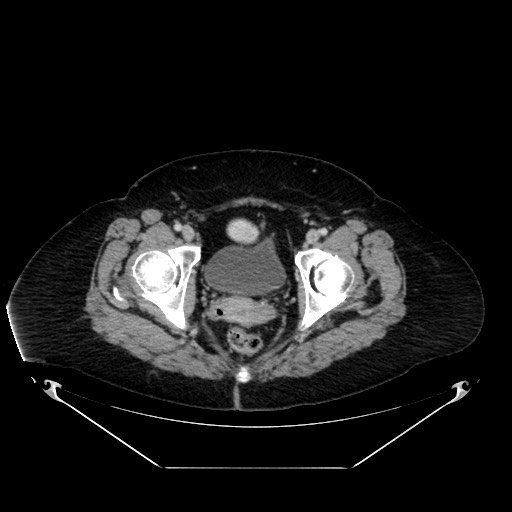 File:Acute appendicitis, heterotaxy syndrome (Radiopaedia 66884-76202 Axial 92).jpg
